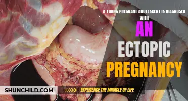 A Shocking Diagnosis: Young Pregnant Adolescent Discovers Ectopic Pregnancy
