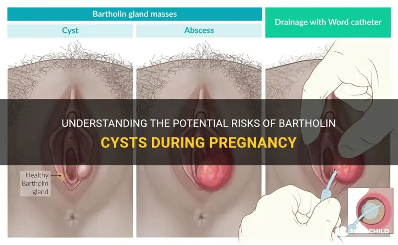 are bartholin cysts dangerous during pregnancy