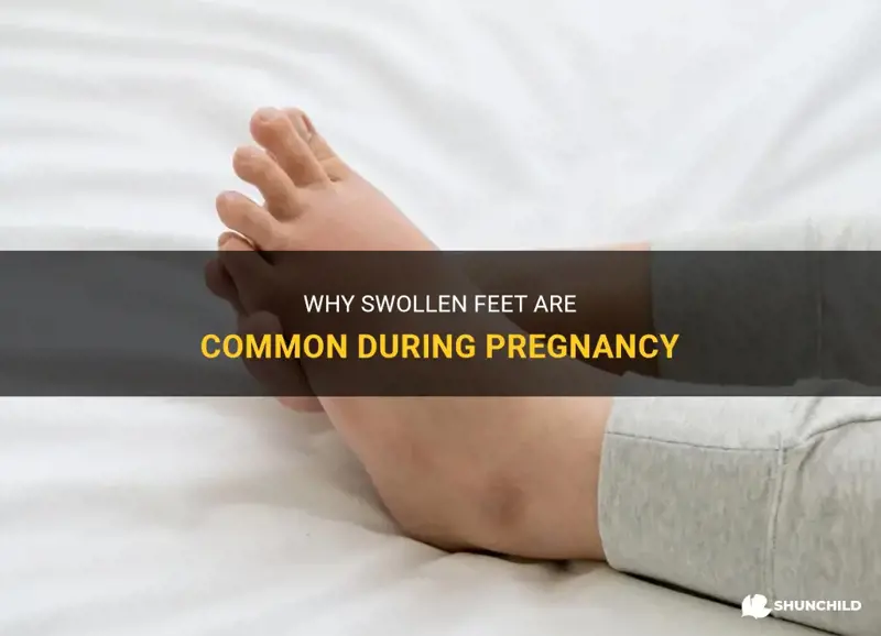 Why Swollen Feet Are Common During Pregnancy | ShunChild