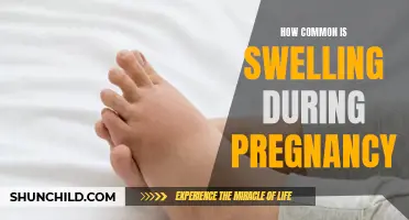 Understanding the Frequency of Swelling During Pregnancy: What to Expect