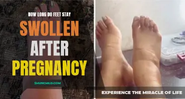 Understanding the Duration of Swollen Feet After Pregnancy