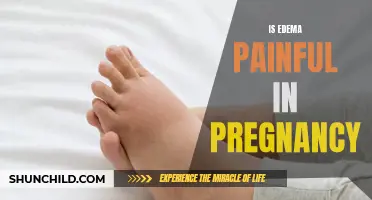 Understanding the Painful Side of Edema in Pregnancy