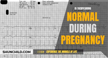 Understanding the Causes and Risks of Tachycardia During Pregnancy