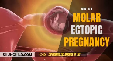 Understanding Molar Ectopic Pregnancy: A Rare and Complex Condition