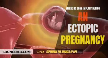 Understanding the Implantation Sites of Eggs in Ectopic Pregnancies